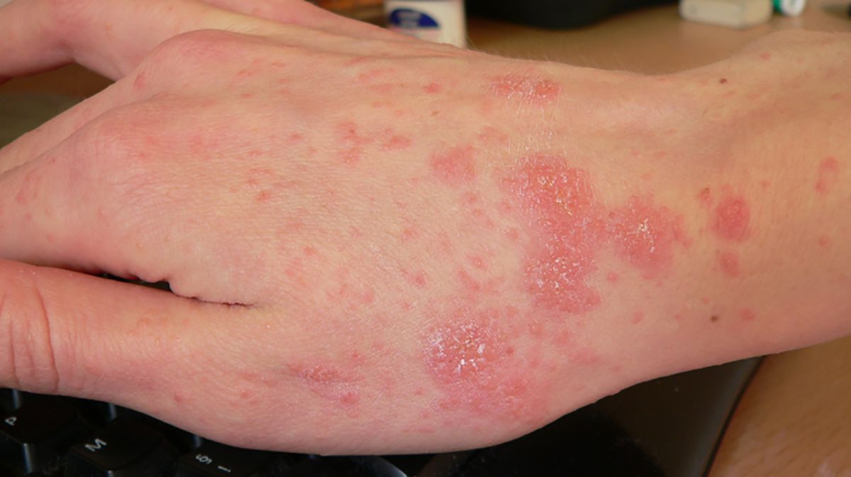 What Are the Causes of Scabies?