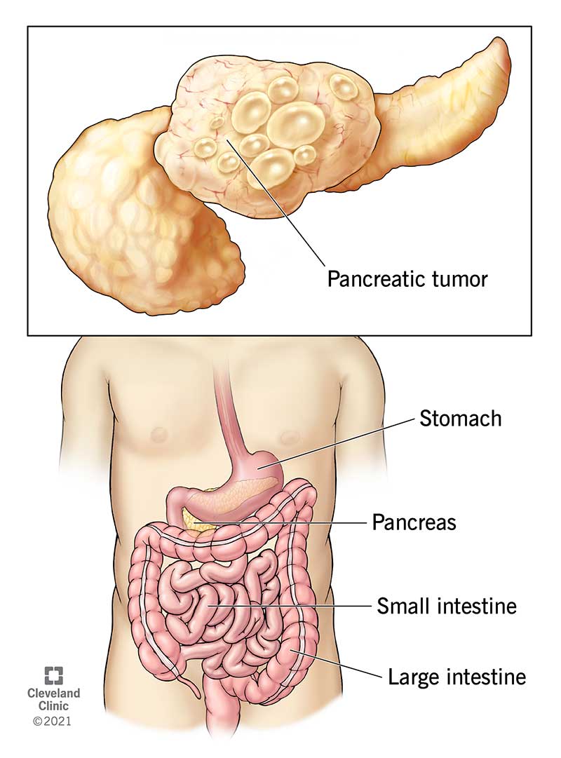 Pancreatic Cancer Diagnosis