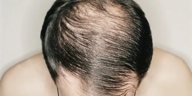 What You Need to Know About Balding Hair ?