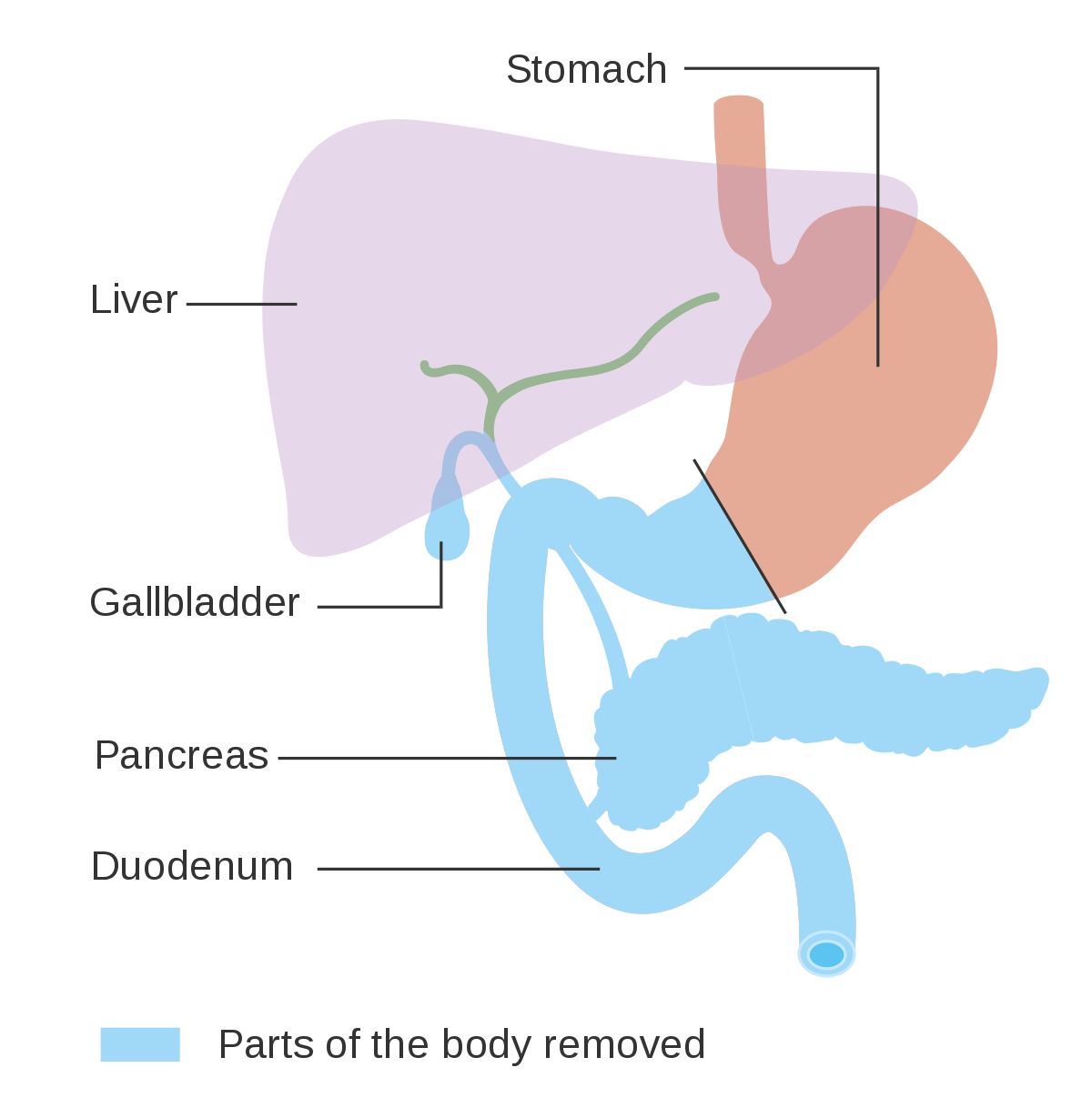 The Procedure of Removing the Pancreas