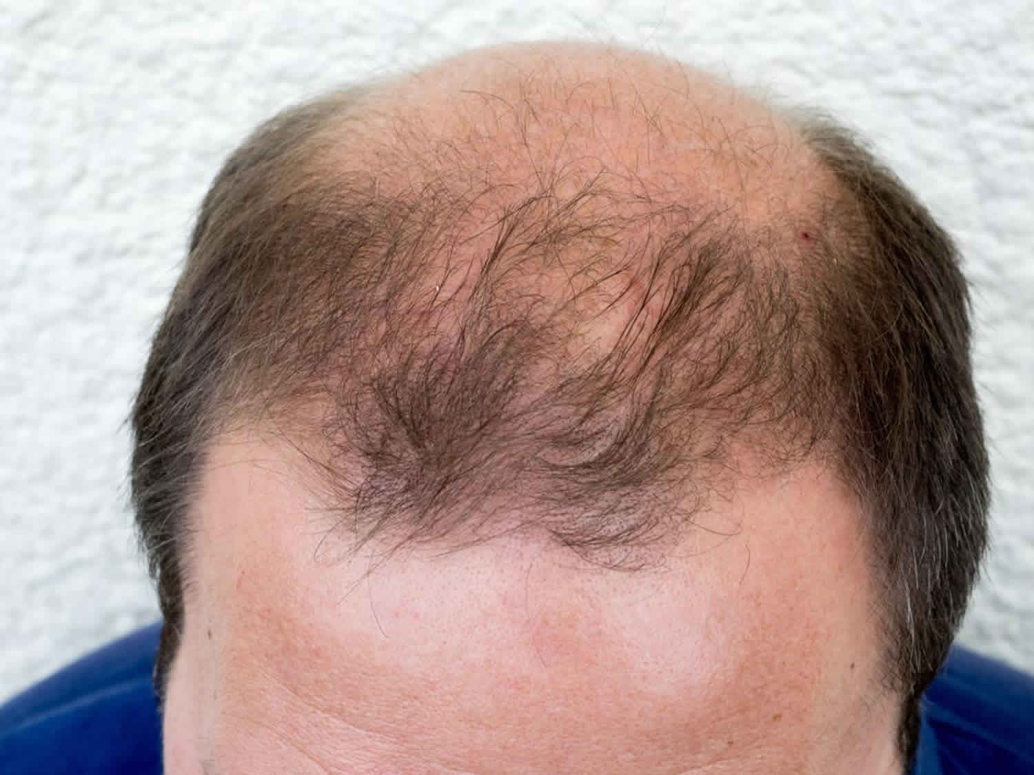 Hair Regrowth For Men at Desertcart