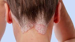 What You Need to Know About Psoriasis