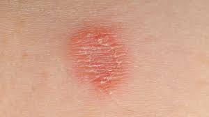 Skin Lesion Symptoms