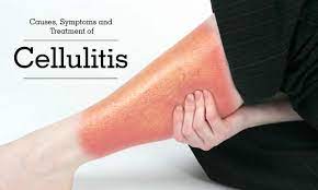Cellulitis - Causes, Symptoms, Treatment, and Prevention