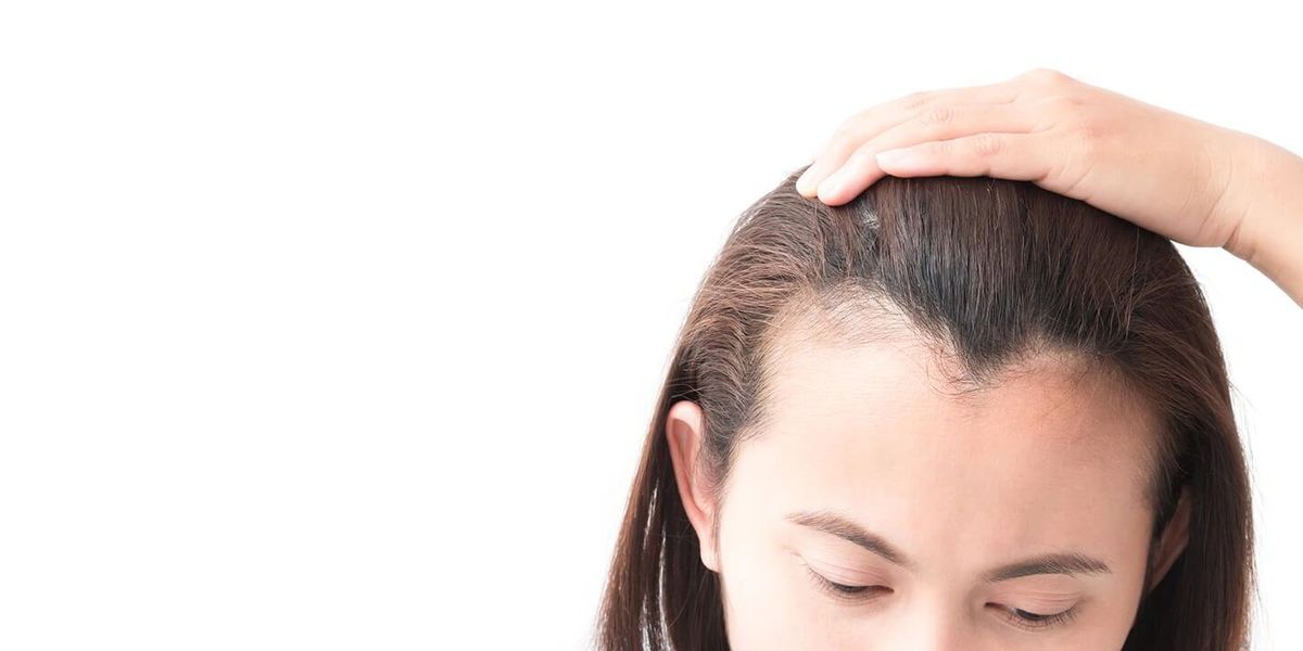 Female Pattern Baldness - Causes, Symptoms, Treatments and Prevention