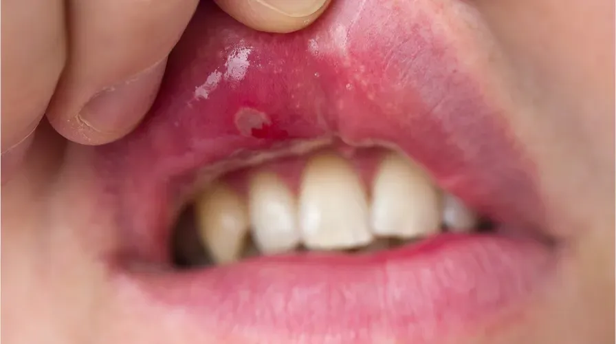 How to Treat a Canker Sore