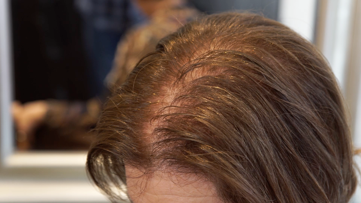 Hair Regrowth For Women - What You Need to Know?