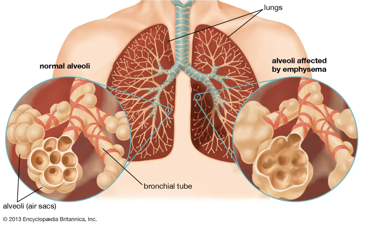 Emphysema - What is Emphysema?