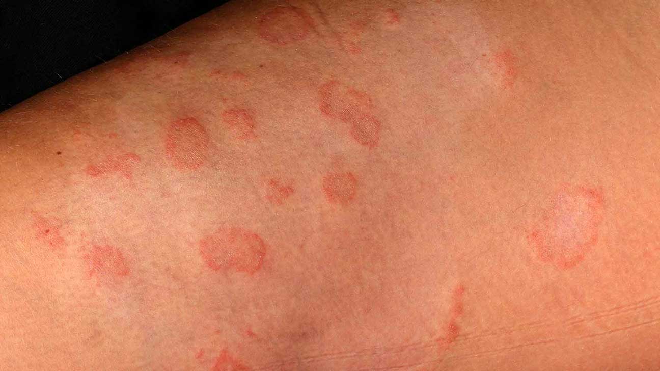Learn More About the Symptoms and Treatment of Ringworm