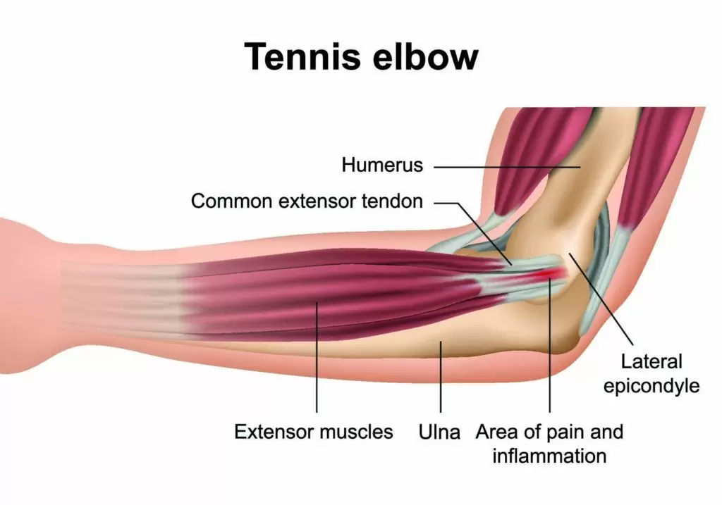 Treatment Options For Tennis Elbow