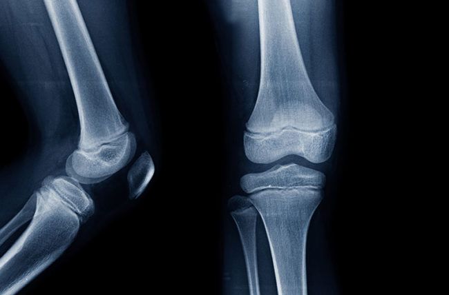 Treatments For Bone Pain in Leg