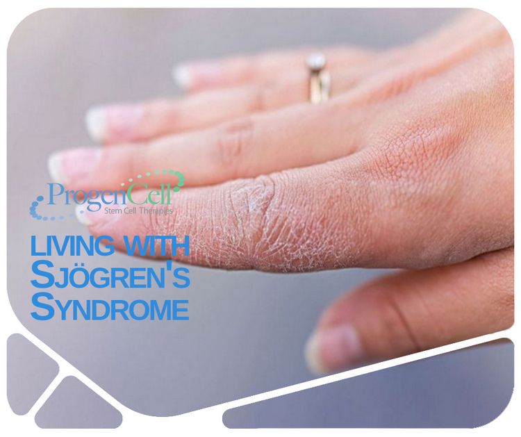 What Are the Symptoms of Sjogrens's Syndrome?