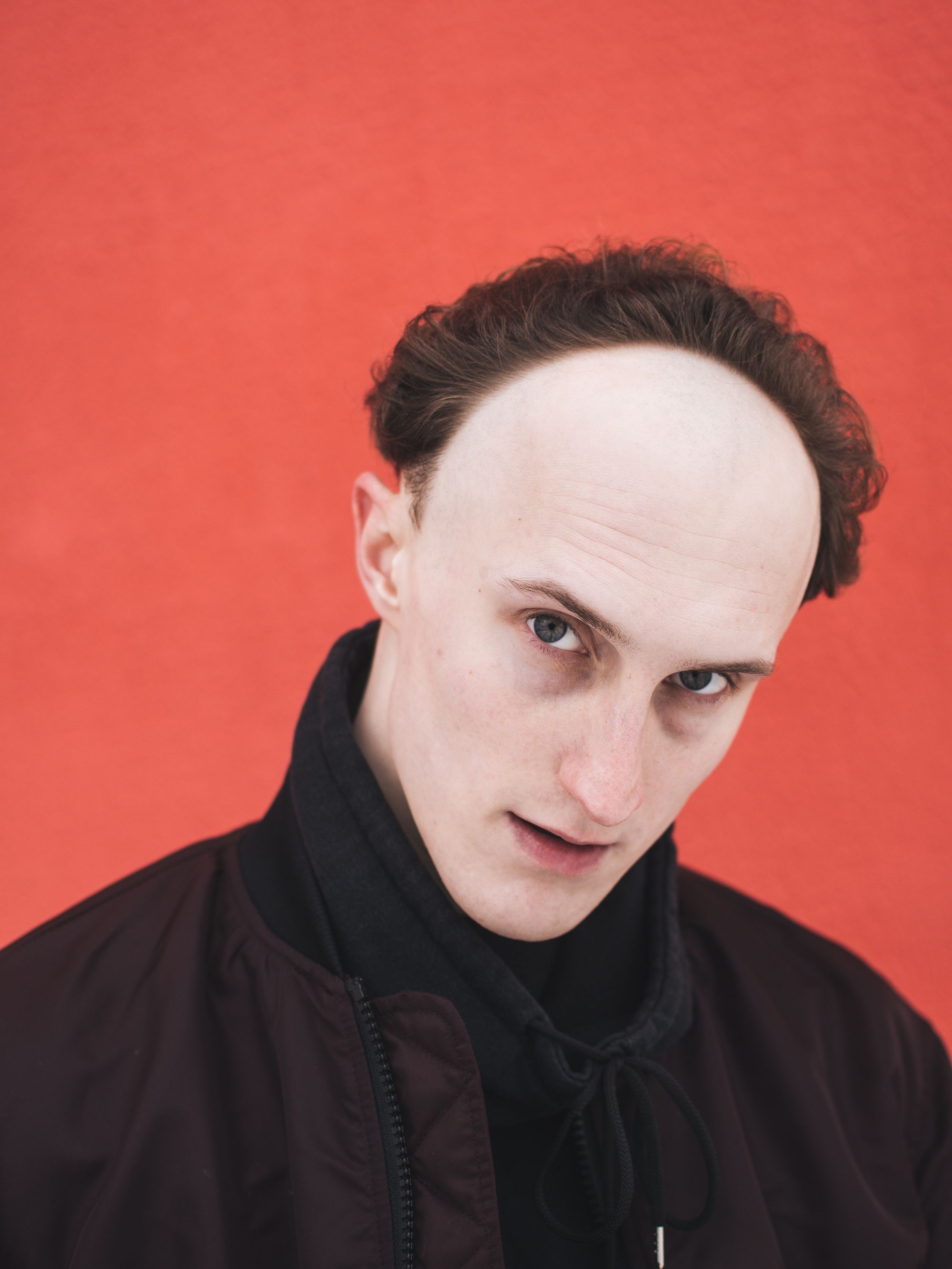 What Are the Signs of a Receding Hairline?
