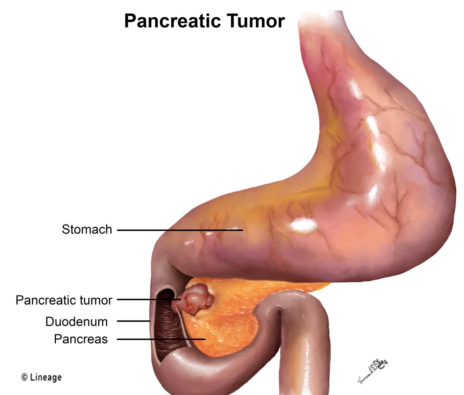 How to Tell If You Have a Pancreatic Tumor?