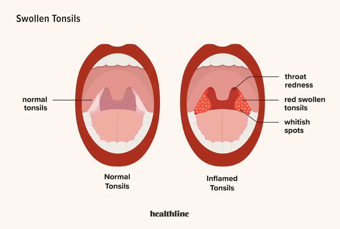 How to Prevent and Treat Tonsillitis