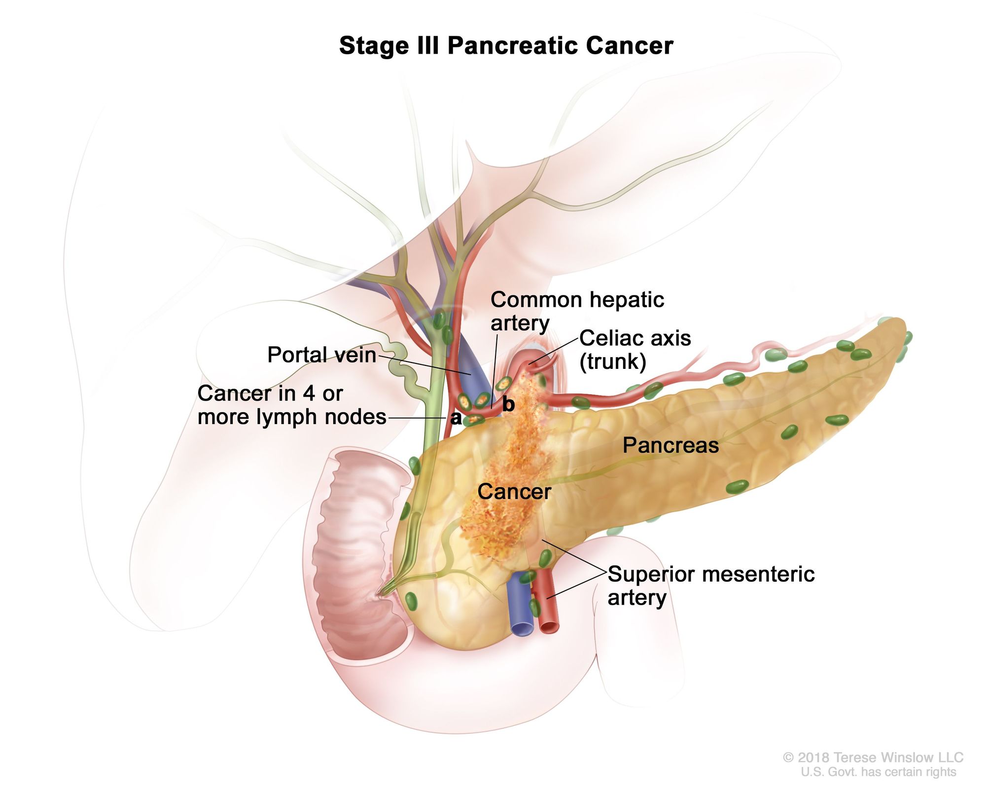 What is Stage 3 Pancreatic Cancer?