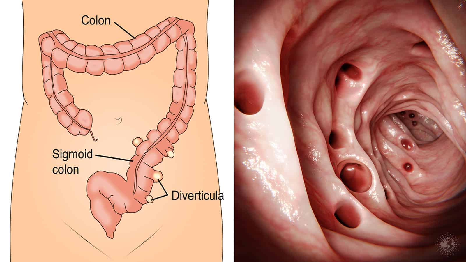 What Treatment Options Are Available For Diverticulitis?