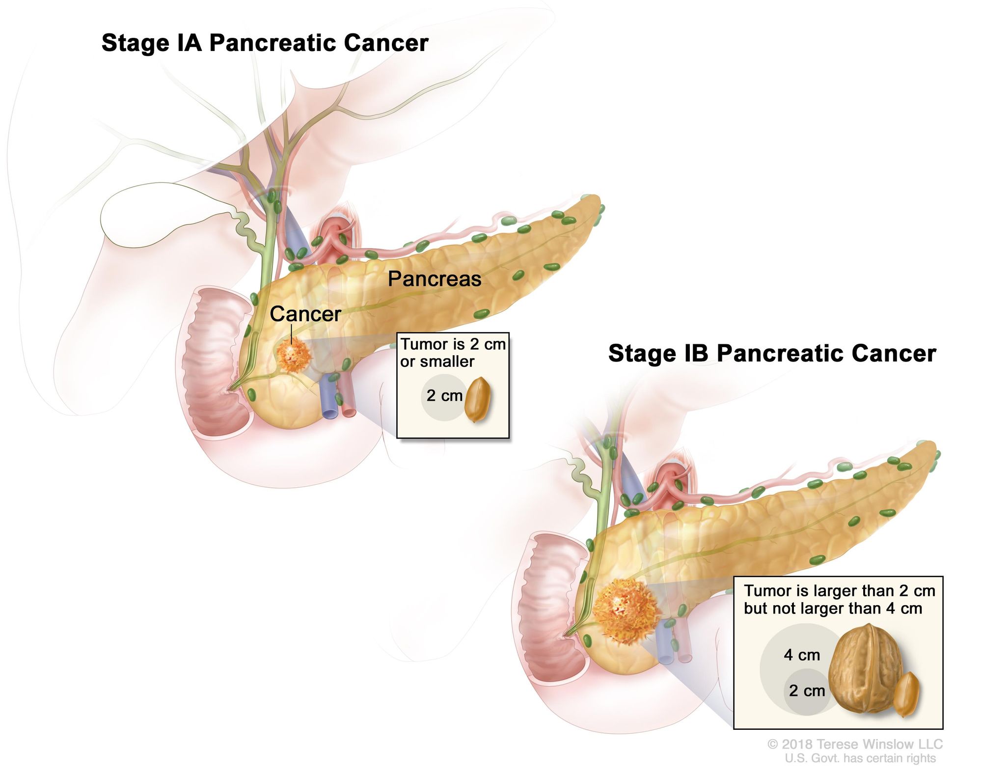 What is Pancreatic Cancer Stage?