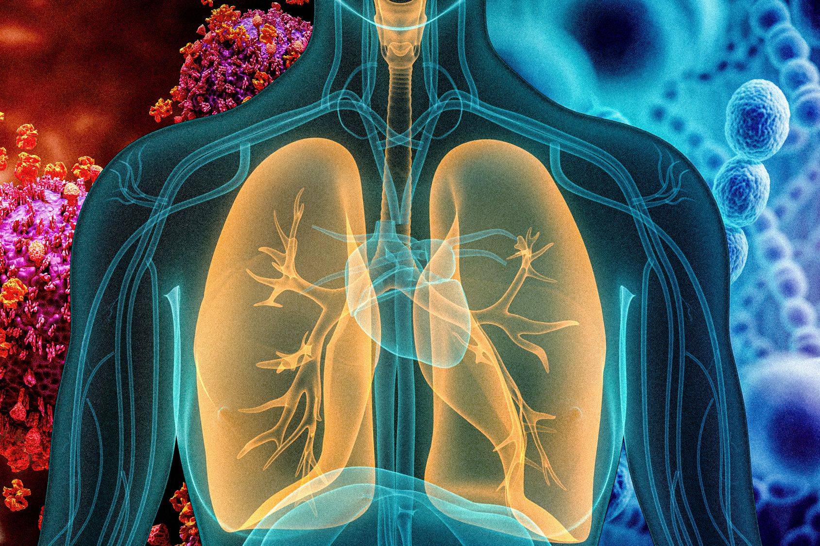 What Are the Signs and Symptoms of Pneumonia?