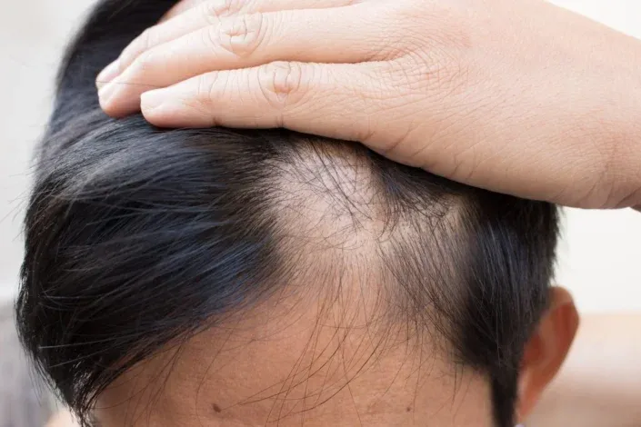 Treatments For a Bald Spot on the Head