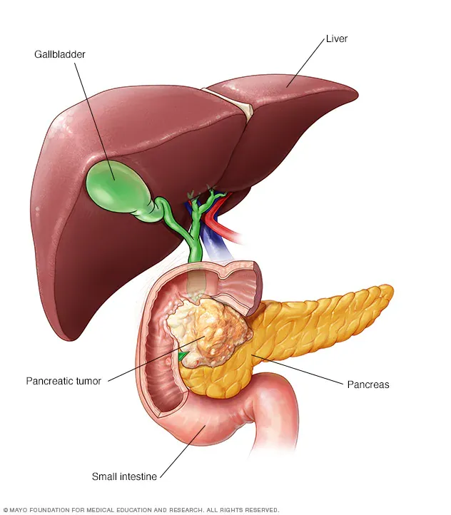 Types of Pancreatic Cancer Treatment