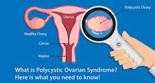 Treatment For Polycystic Ovarian Syndrome (PCOs)