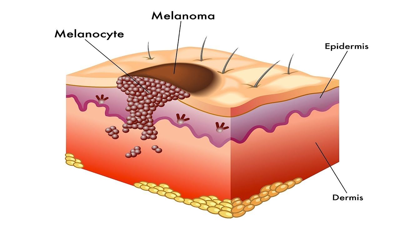 Melanoma Detection and Treatment