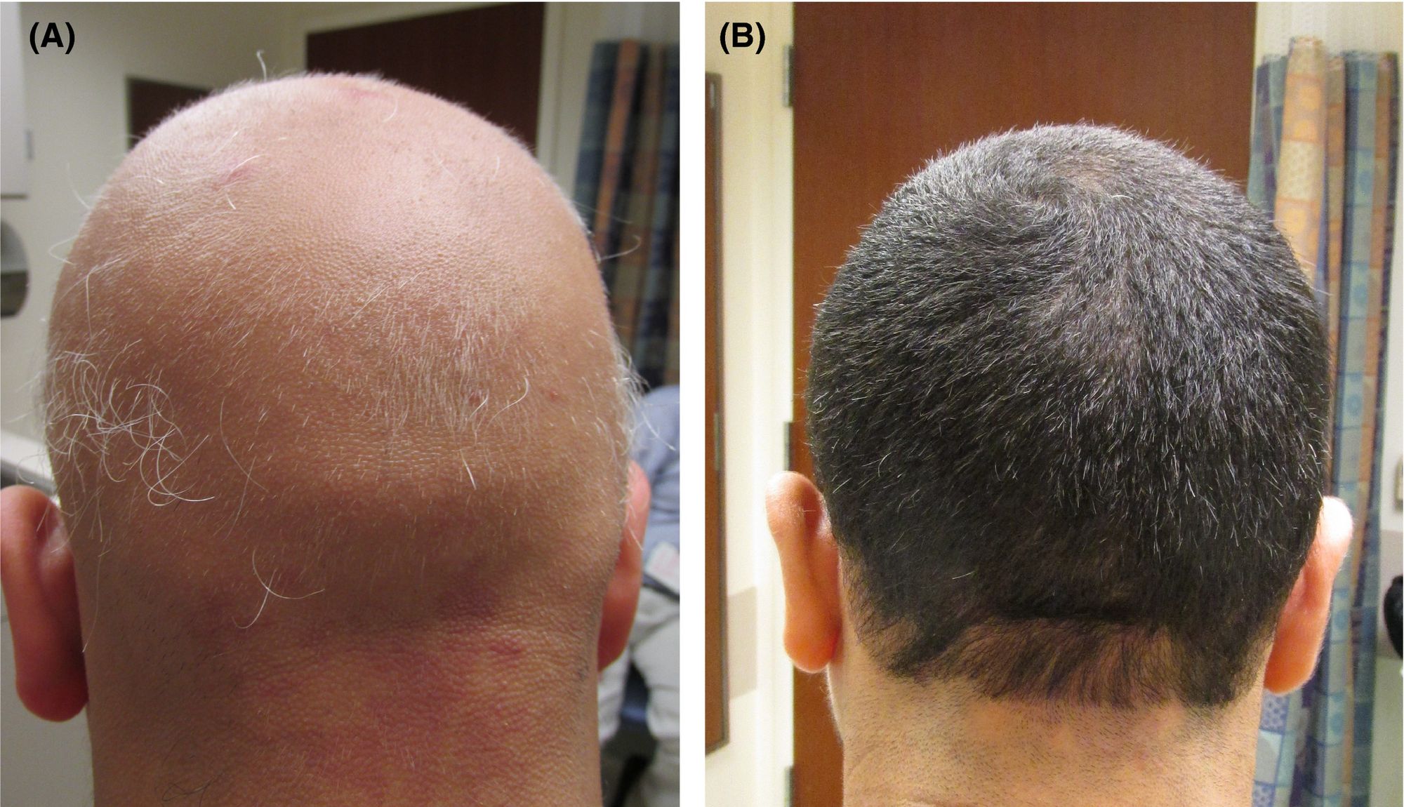 Alopecia Totalis - Causes and Natural Treatments