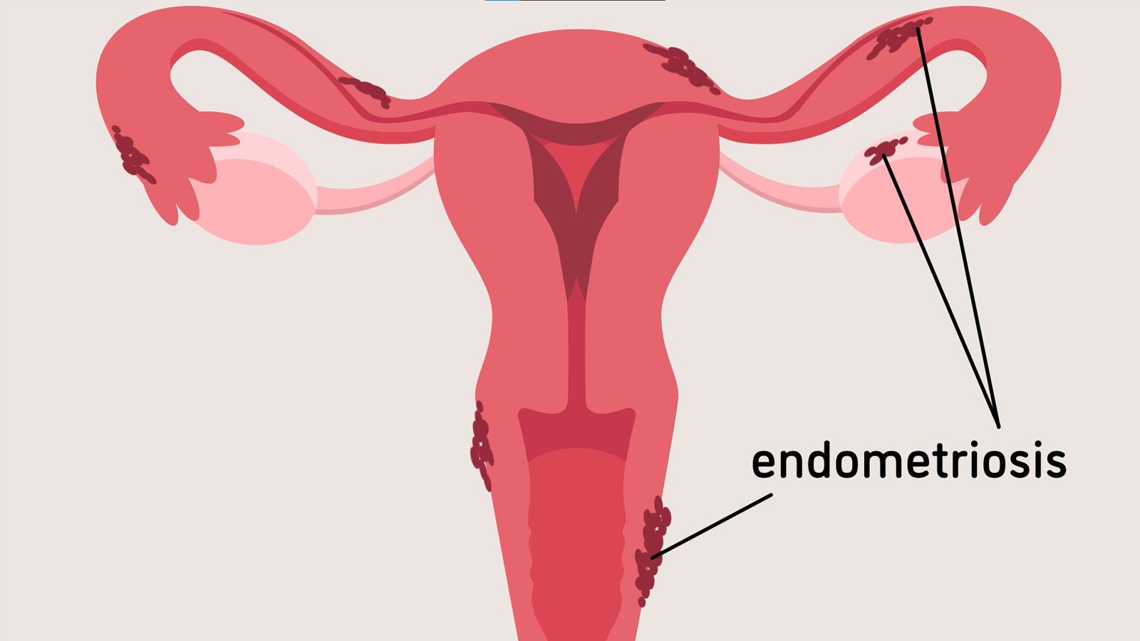 Endometriosis - Symptoms, Diagnosis, and Treatments For Endometriosis