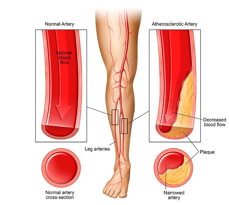 What Causes Leg Pain?