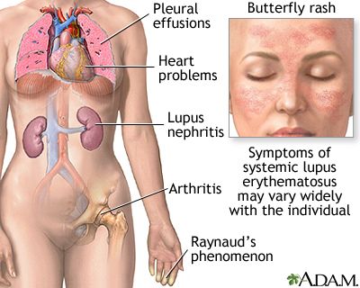 Systemic Lupus Erythematosus Symptoms
