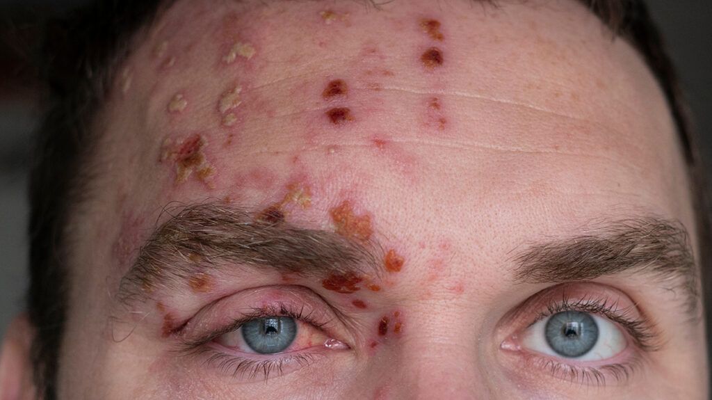 Is Shingles Contagious?