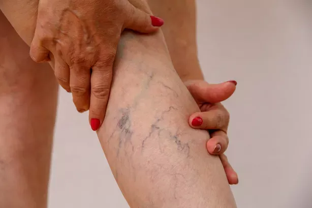Vein Pain in the Leg - Causes and Treatments