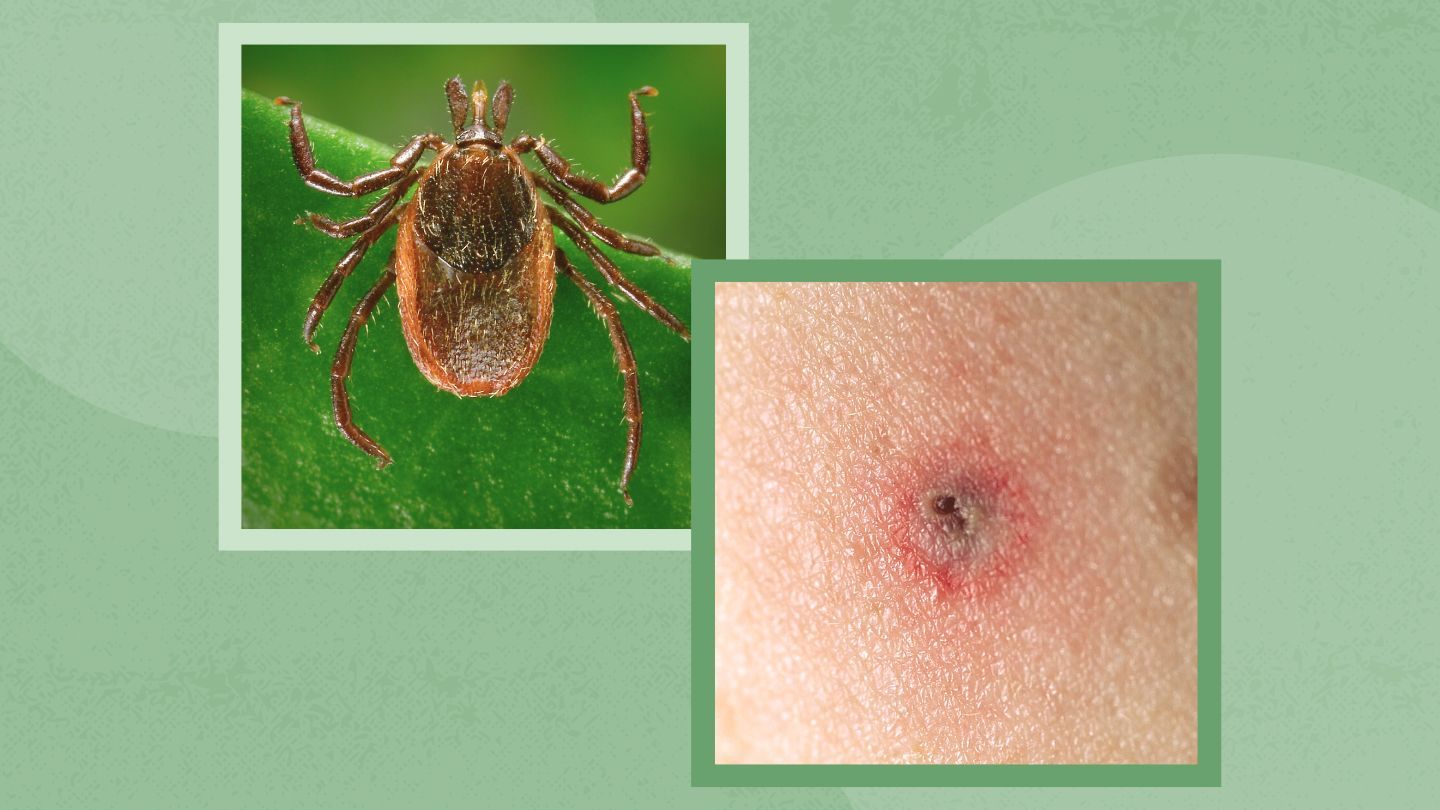 How to Treat a Tick Bite