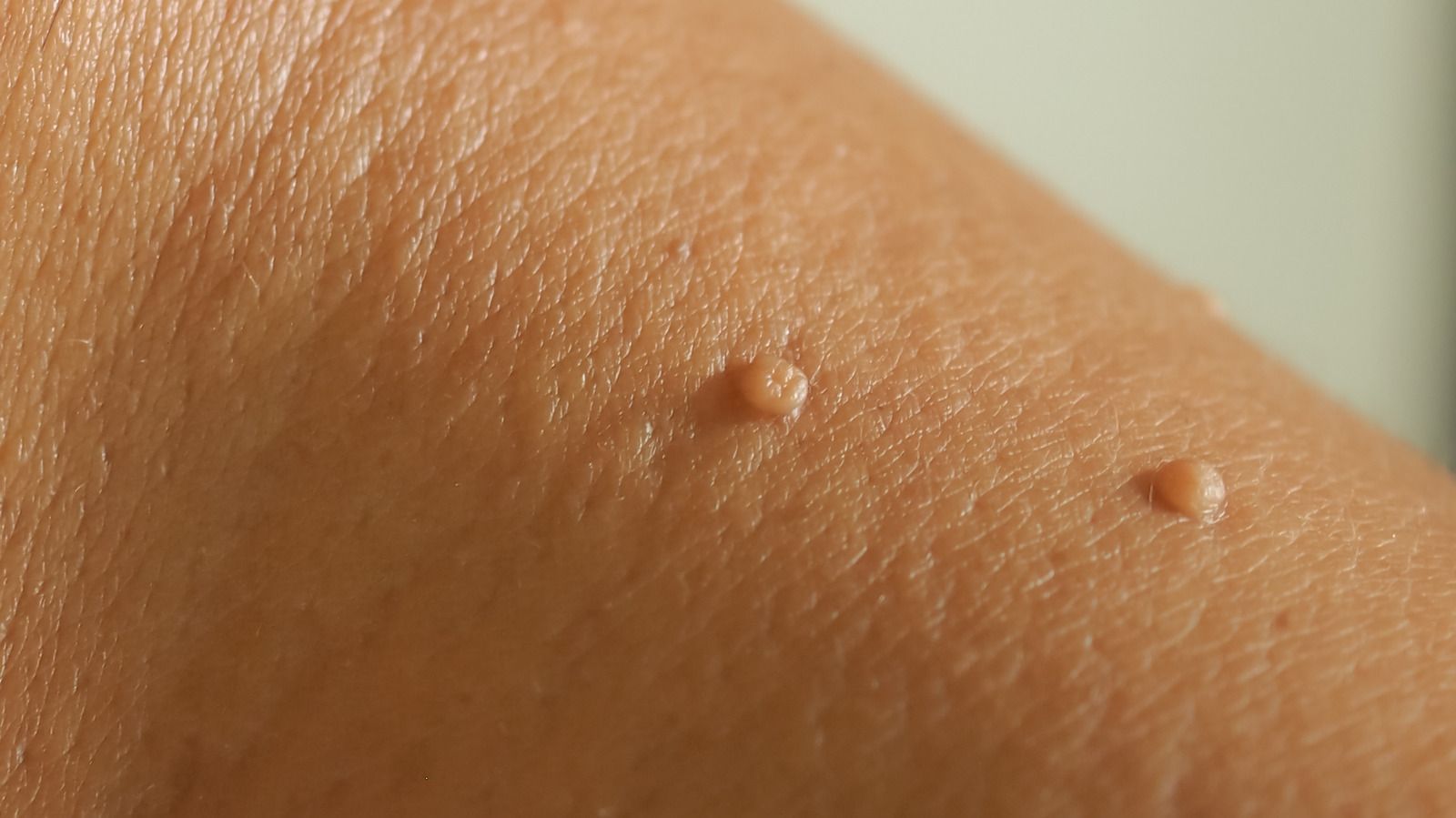 Best Methods for Skin Tag Removal
