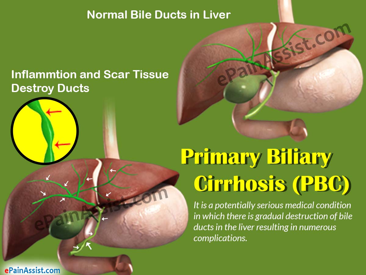 Primary Biliary Cholangitis Treatment