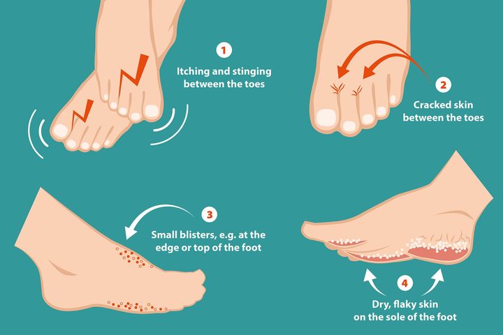 Athlete's Foot Home Remedies