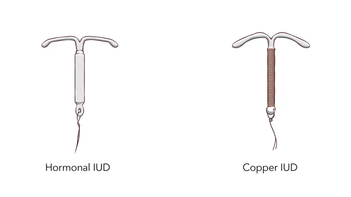 Risks of an IUD