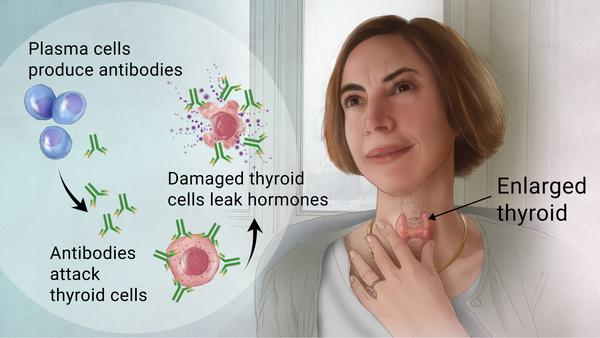 Symptoms of Autoimmune Thyroiditis